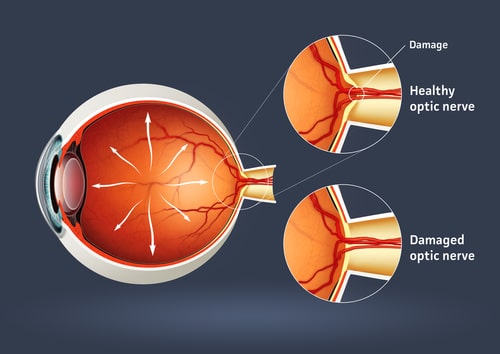 Glaucoma Diagram