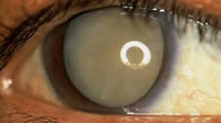 Mature Cataract