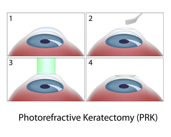 PRK Chart